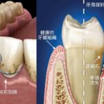 牙齦流血別再怪牙刷！元凶牙菌斑忽略不理危害更大，3步驟教你徹底根除牙周疾病