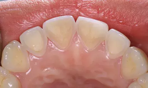 戒掉四種超傷琺瑯質的壞習慣！第一種讓牙齒脆弱到刷牙也可能受傷