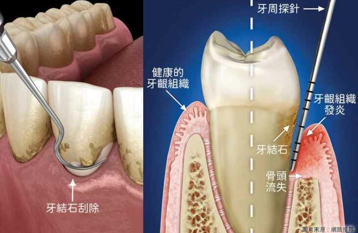 牙齦流血別再怪牙刷！元凶牙菌斑忽略不理危害更大，3步驟教你徹底根除牙周疾病