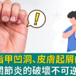 別小看指甲凹洞、皮膚起屑的警告！乾癬性關節炎的破壞不可逆