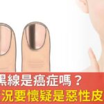 指甲有黑線是癌症嗎？醫：5狀況要懷疑是惡性皮膚癌